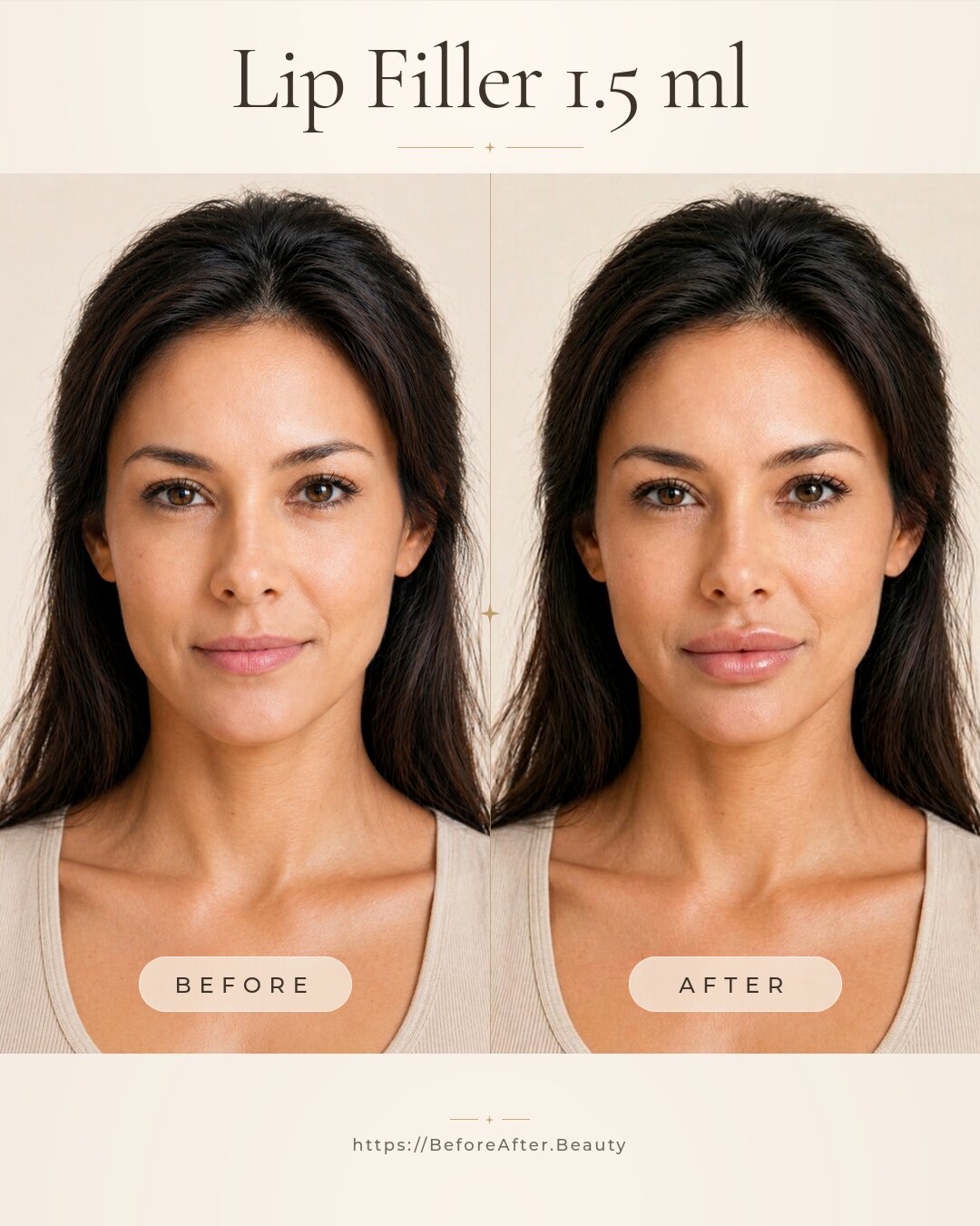 Lip filler 1.5 ml