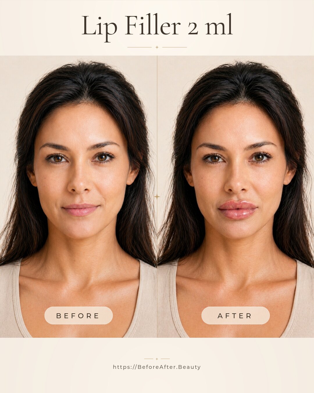 Lip filler 2 ml